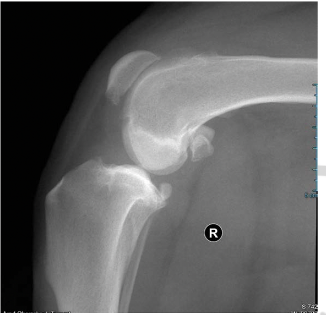X-ray of a dog's stifle (knee) with a torn CCL (ACL)